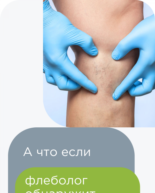 А что если флеболог обнаружит варикоз у себя?