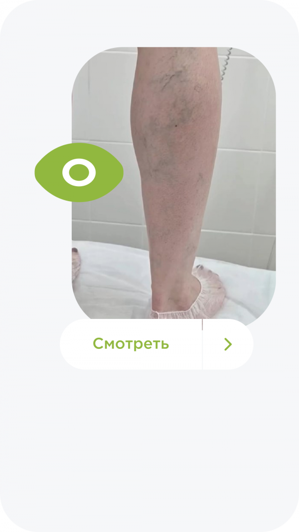Как избежать варикоза в беременность