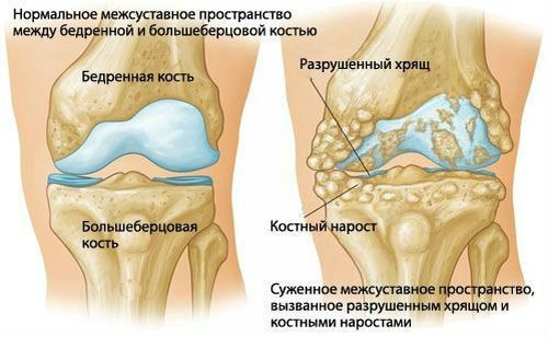 analize pt artroza)